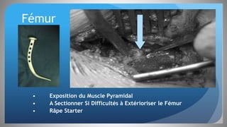 Fémur
• Exposition du Muscle Pyramidal
• A Sectionner Si Difficultés à Extérioriser le Fémur
• Râpe Starter
 