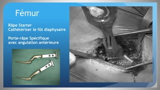 Fémur
Râpe Starter
Cathétériser le fût diaphysaire
Porte-râpe Spécifique
avec angulation antérieure
 