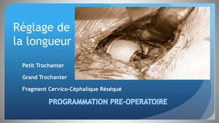 Réglage de
la longueur
Petit Trochanter
Grand Trochanter
Fragment Cervico-Céphalique Réséqué
 