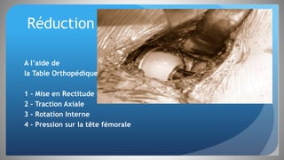 Réduction
A l’aide de
la Table Orthopédique
1 - Mise en Rectitude
2 - Traction Axiale
3 - Rotation Interne
4 - Pression sur la tête fémorale
 