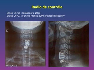 Radio de contrôle Etage C5-C6 : Strasbourg  2003 Etage C6-C7 : Fort-de-France 2009 prothèse Discocerv 