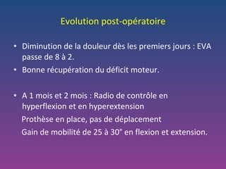 Evolution post-opératoire Diminution de la douleur dès les premiers jours : EVA passe de 8 à 2. Bonne récupération du déficit moteur. A 1 mois et 2 mois : Radio de contrôle en hyperflexion et en hyperextension Prothèse en place, pas de déplacement Gain de mobilité de 25 à 30° en flexion et extension.  