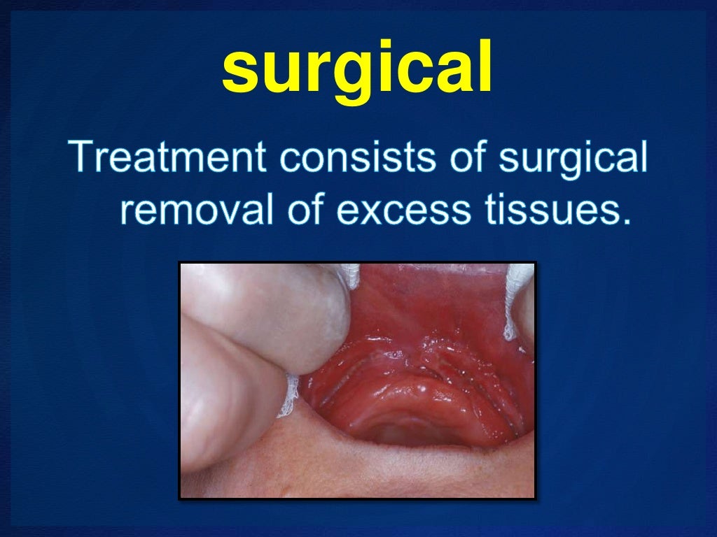 Management of Epulis fissuratum