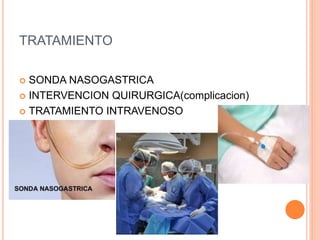 TRATAMIENTO
 SONDA NASOGASTRICA
 INTERVENCION QUIRURGICA(complicacion)
 TRATAMIENTO INTRAVENOSO
 