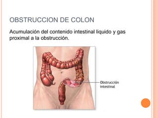 OBSTRUCCION DE COLON
Acumulación del contenido intestinal liquido y gas
proximal a la obstrucción.
 