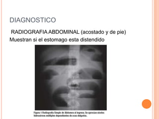 DIAGNOSTICO
RADIOGRAFIA ABDOMINAL (acostado y de pie)
Muestran si el estomago esta distendido
 