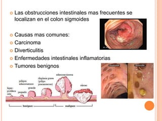  Las obstrucciones intestinales mas frecuentes se
localizan en el colon sigmoides
 Causas mas comunes:
 Carcinoma
 Diverticulitis
 Enfermedades intestinales inflamatorias
 Tumores benignos
 