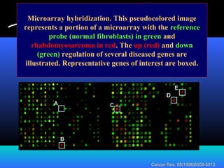 Microarray hybridization. This pseudocolored image
represents a portion of a microarray with the reference
probe (normal fibroblasts) in green and
rhabdomyosarcoma in red. The up (red) and down
(green) regulation of several diseased genes are
illustrated. Representative genes of interest are boxed.
Cancer Res. 58(1998)5009-5013
 