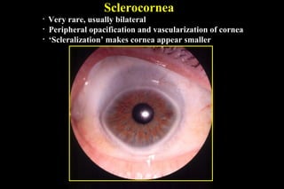 Sclerocornea
• Very rare, usually bilateral
• Peripheral opacification and vascularization of cornea
• ‘Scleralization’ makes cornea appear smaller