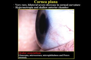 Cornea plana
• Very rare, bilateral severe decrease in corneal curvature
• Hypermetropia and shallow anterior chamber
Ocular associations
Glaucoma, microcornea, microphthalmos and Peters
anomaly
