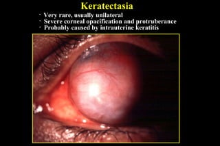 Keratectasia
• Very rare, usually unilateral
• Severe corneal opacification and protruberance
• Probably caused by intrauterine keratitis