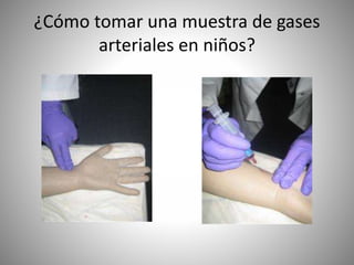 ¿Cómo tomar una muestra de gases
arteriales en niños?
 