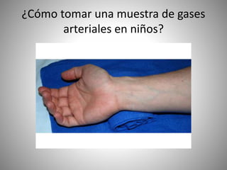 ¿Cómo tomar una muestra de gases
arteriales en niños?
 