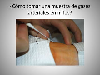 ¿Cómo tomar una muestra de gases
arteriales en niños?
 
