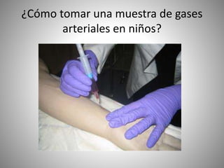 ¿Cómo tomar una muestra de gases
arteriales en niños?
 