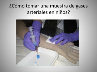 ¿Cómo tomar una muestra de gases
arteriales en niños?
 