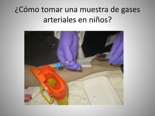 ¿Cómo tomar una muestra de gases
arteriales en niños?
 