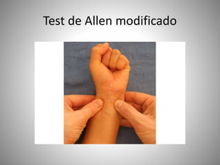 Test de Allen modificado
 
