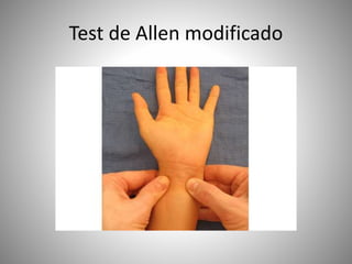 Test de Allen modificado
 