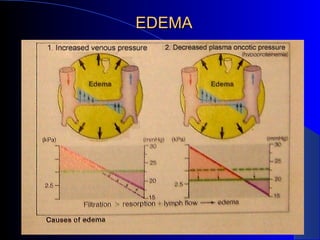 EDEMA 