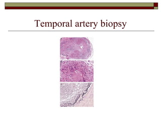 Temporal artery biopsy 