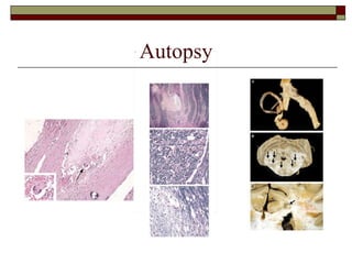 Autopsy 