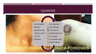Equimosis, hematoma diferencia entre equimosis y hematoma | PPT