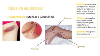 Equimosis y hematoma | PPT