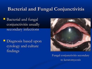 Bacterial and Fungal ConjunctivitisBacterial and Fungal Conjunctivitis
 Bacterial and fungalBacterial and fungal
conjunct...