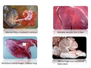 Multifocal hemorrhages, rubbery lung
Multiple necrotic foci in liver
Hemorrhage and necrosis of
brain stem
Aborted fetus, enclosed in amnion
 