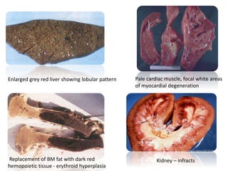 Enlarged grey red liver showing lobular pattern
Replacement of BM fat with dark red
hemopoietic tissue - erythroid hyperplasia
Pale cardiac muscle, focal white areas
of myocardial degeneration
Kidney – infracts
 
