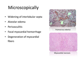 Microscopically
• Widening of interlobular septa
• Alveolar edema
• Perivasculitis
• Focal myocardial hemorrhage
• Degeneration of myocardial
fibers
Pulmonary edema
Myocardial necrosis
 