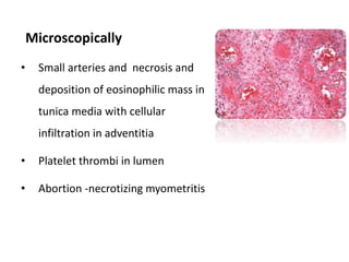 Microscopically
• Small arteries and necrosis and
deposition of eosinophilic mass in
tunica media with cellular
infiltration in adventitia
• Platelet thrombi in lumen
• Abortion -necrotizing myometritis
 