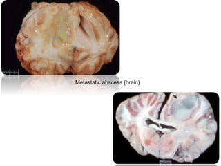 Metastatic abscess (brain)
 