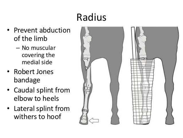 robert jones bandage