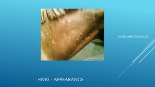 HIVES - APPEARANCE
HIVES WITH CRUSTING
 
