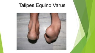 Equinus | PPTX