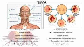 • Tumores de cabeça e pescoço
• Tumores de pele
• Tumores do sistema digestivo
• Tumores do sistema urinário
• Tumores do cérebro e do sistema nervoso
• Tumores do sistema reprodutivo
• Tumores de mama
• Tumores do sistema endócrino
• Tumores do olho
• Tumores do sangue e do sistema linfático
• Tumores dos ossos e tecidos moles
• Tumores pulmonares
TIPOS
 