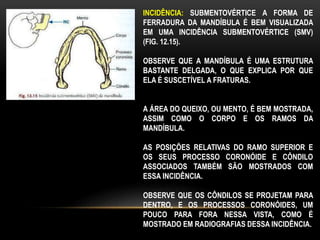 INCIDÊNCIA: SUBMENTOVÉRTICE A FORMA DE
FERRADURA DA MANDÍBULA É BEM VISUALIZADA
EM UMA INCIDÊNCIA SUBMENTOVÉRTICE (SMV)
(FIG. 12.15).
OBSERVE QUE A MANDÍBULA É UMA ESTRUTURA
BASTANTE DELGADA, O QUE EXPLICA POR QUE
ELA É SUSCETÍVEL A FRATURAS.
A ÁREA DO QUEIXO, OU MENTO, É BEM MOSTRADA,
ASSIM COMO O CORPO E OS RAMOS DA
MANDÍBULA.
AS POSIÇÕES RELATIVAS DO RAMO SUPERIOR E
OS SEUS PROCESSO CORONÓIDE E CÔNDILO
ASSOCIADOS TAMBÉM SÃO MOSTRADOS COM
ESSA INCIDÊNCIA.
OBSERVE QUE OS CÔNDILOS SE PROJETAM PARA
DENTRO, E OS PROCESSOS CORONÓIDES, UM
POUCO PARA FORA NESSA VISTA, COMO É
MOSTRADO EM RADIOGRAFIAS DESSA INCIDÊNCIA.
 