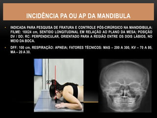 INCIDÊNCIA PA OU AP DA MANDIBULA
• INDICADA PARA PESQUISA DE FRATURA E CONTROLE PÓS-CIRÚRGICO NA MANDIDIBULA;
FILME: 18X24 cm, SENTIDO LONGITUDINAL EM RELAÇÃO AO PLANO DA MESA; POSIÇÃO
DV / DD; RC: PERPENDICULAR, ORIENTADO PARA A REGIÃO ENTRE OS DOIS LÁBIOS, NO
MEIO DA BOCA.
• DFF: 100 cm, RESPIRAÇÃO: APNEIA; FATORES TÉCNICOS: MAS – 200 A 300, KV – 70 A 80,
MA – 20 A 30.
 