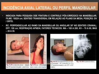 INCIDÊNCIA AXIAL LATERAL OU PERFIL MANDÍBULAR
• INDICADA PARA PESQUISA DDE FRATURA E CONTROLE PÓS-CIRRÚGICO NA MANDÍBULAR;
FILME: 18X24 cm; SENTIDO TRANSVERSAL EM RELAÇÃO AO PLANO DA MESA; POSIÇÃO: DV
/ ORTO.
• RC: PERPENDICULAR AO RAMO DA MANDIBULAR OU ANGULAR 30º NO SENTIDO CRANIAL;
DFF: 100 cm; RESPIRAÇÃO APNEIA; FATORES TÉCNICOS: MA – 100 A 200, KV – 70 A 80, MAS
– 20 A 30.
 