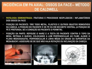 INCIDÊNCIA EM PA AXIAL: OSSOS DA FACE-- MÉTODO
DE CALDWELL
• PATOLOGIA DEMONSTRADA: FRATURAS E PROCESSOS NEOPLÁSICOS / INFLAMATÓRIOS
DOS OSSOS DA FACE
• POSIÇÃO DO PACIENTE: TIRE TODO METAL, PLÁSTICO E OUTROS OBJETOS REMOVÍVEIS
DA CABEÇA. A POSIÇÃO DO PACIENTE É DE PÉ OU EM DECÚBITO VENTRAL (A POSIÇÃO DE
PÉ É PREFERIDA, SE A CONDIÇÃO DO PACIENTE O PERMITIR).
• POSIÇÃO DA PARTE: REPOUSE O NARIZ E A TESTA DO PACIENTE CONTRA O TOPO DA
MESA. RETRAIA O QUEIXO, COLOCANDO A LOM PERPENDICULAR AO FILME. ALINHE O
PLANO MEDIOSSAGITAL PERPENDICULAR À LINHA MÉDIA DA GRADE OU SUPERFÍCIE DA
MESA/BUCKY. ASSEGURE-SE DE QUE NÃO HAJA ROTAÇÃO OU INCLINAÇÃO DA CABEÇA.
 