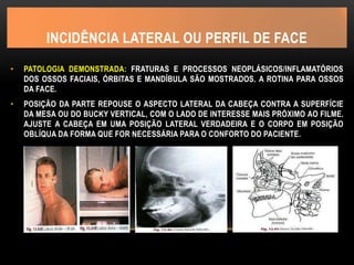 INCIDÊNCIA LATERAL OU PERFIL DE FACE
• PATOLOGIA DEMONSTRADA: FRATURAS E PROCESSOS NEOPLÁSICOS/INFLAMATÓRIOS
DOS OSSOS FACIAIS, ÓRBITAS E MANDÍBULA SÃO MOSTRADOS. A ROTINA PARA OSSOS
DA FACE.
• POSIÇÃO DA PARTE REPOUSE O ASPECTO LATERAL DA CABEÇA CONTRA A SUPERFÍCIE
DA MESA OU DO BUCKY VERTICAL, COM O LADO DE INTERESSE MAIS PRÓXIMO AO FILME.
AJUSTE A CABEÇA EM UMA POSIÇÃO LATERAL VERDADEIRA E O CORPO EM POSIÇÃO
OBLÍQUA DA FORMA QUE FOR NECESSÁRIA PARA O CONFORTO DO PACIENTE.
 