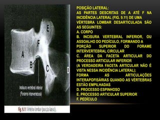 POSIÇÃO LATERAL:
AS PARTES DESCRITAS DE A ATÉ F NA
INCIDÊNCIA LATERAL (FIG. 9.11) DE UMA
VÉRTEBRA LOMBAR DESARTICULADA SÃO
AS SEGUINTES:
A. CORPO
B. INCISURA VERTEBRAL INFERIOR, OU
ASSOALHO DO PEDÍCULO, FORMANDO A
PORÇÃO SUPERIOR DO FORAME
INTERVERTEBRAL CIRCULAR
C. ÁREA DA FACETA ARTICULAR DO
PROCESSO ARTICULAR INFERIOR
(A VERDADEIRA FACETA ARTICULAR NÃO É
VISTA NESSA INCIDÊNCIA LATERAL);
FORMA AS ARTICULAÇÕES
INTERAPOFISÁRIAS QUANDO AS VÉRTEBRAS
ESTÃO EMPILHADAS
D. PROCESSO ESPINHOSO
E. PROCESSO ARTICULAR SUPERIOR
F. PEDÍCULO
 