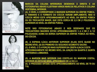 MARCOS DA COLUNA INFERIOROS DESENHOS À DIREITA E AS
FOTOGRAFIAS ABAIXO ILUSTRAM VÁRIOS MARCOS RELATIVOS À COLUNA
VERTEBRAL INFERIOR.
(A). O NÍVEL A CORRESPONDE À MARGEM SUPERIOR DA SÍNFISE PÚBICA.
O TAMANHO E O FORMATO DO CÓCCIX VARIAM AMPLAMENTE, MAS O
CÓCCIX MÉDIO ESTÁ APROXIMADAMENTE AO NÍVEL DA SÍNFISE PÚBICA
OU DO TROCANTER MAIOR, QUE ESTÁ CERCA DE 2,5 CM (1 POLEGADA)
SUPERIOR AO NÍVEL DA SÍNFISE PÚBICA.
NOTE NAS FOTOGRAFIAS ABAIXO E NOS DESENHOS QUE OS
TROCANTERES MAIORES ESTÃO APROXIMADAMENTE 3 A 4 CM (1 A 1/2
POLEGADAS) ACIMA DA BORDA SUPERIOR DA SÍNFISE PÚBICA AO NÍVEL
DO CÓCCIX.
(B). A ESPINHA ILÍACA ANTERIOR SUPERIOR (ELAS) ESTÁ QUASE NO
MESMO NÍVEL (B) DO PRIMEIRO OU SEGUNDO SEGMENTO SACRA!.
(C). O NÍVEL C É A PORÇÃO MAIS SUPERIOR DA CRISTA ILÍACA E ESTÁ
APROXIMADAMENTE NO MESMO NÍVEL DA JUNÇÃO DA QUARTA E QUINTA
VÉRTEBRAS LOMBARES.
(D). A MARGEM MAIS INFERIOR DAS COSTELAS OU MARGEM COSTAL
INFERIOR (D) ESTÁ NO NÍVEL APROXIMADO DE L2 OU L3.
(E). O PROCESSO XIFÓIDE ESTÁ APROXIMADAMENTE AO NÍVEL DE T9 OU
T10.
 