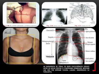 TRAQUEIA
NA RADIOGRAFIA DE TÓRAX, OS SEIOS COSTO-FRÊNICOS (ESPAÇO
ENTRE OS ARCOS COSTAIS E O DIAFRAGMA) PERMEÁVEIS, MOSTRAM
QUE NÃO TEM DERRAME PLEURAL (LIQUIDO, HEMORRÁGICO OU
PURULENTO).
TRAQUEIA
 