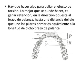 • Hay que hacer algo para paliar el efecto de
  torsión. Lo mejor que se puede hacer, es
  ganar retención, en la dirección opuesta al
  brazo de palanca, hasta una distancia del eje
  que une los pilares primarios equivalente a la
  longitud de dicho brazo de palanca
 