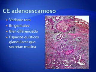    Variante rara
   En genitales
   Bien diferenciado
   Espacios quísticos
    glandulares que
    secretan mucina
 
