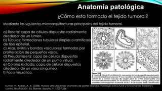 ¿Cómo esta formado el tejido tumoral?
Mediante las siguientes microarquitecturas principales del tejido tumoral.
a) Roseta: capa de células dispuestas radialmente
alrededor de un lumen.
b) Túbulos: formaciones tubulares simples o ramificadas
de tipo epitelial.
c) Asas, ovillos y bandas vasculares: formados por
proliferación de pequeños vasos.
d) Pseudorroseta: capa de células dispuestas
radialmente alrededor de un punto virtual.
e) Corona radiada: capa de células dispuestas radialmente
alrededor de un vaso sanguíneo.
f) Foco necrotico.
Anatomía patológica
Kumar, V., Abbas, A., K. (2008). Huesos articulaciones y tumores de partes blandas. Patología estructural y funcional de Robbins y
contra. 8va Edición. Ed. Elsevier, España. P. 1205-1256
 