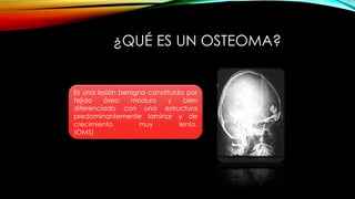 ¿QUÉ ES UN OSTEOMA?
Es una lesión benigna constituida por
tejido óseo maduro y bien
diferenciado con una estructura
predominantemente laminar y de
crecimiento muy lento.
(OMS)
 